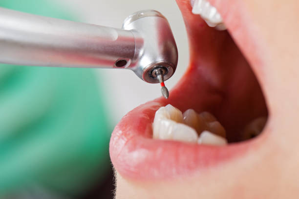 Best Emergency Wisdom Teeth Removal in Glenvar Heights, FL